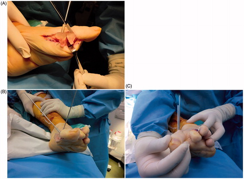 Figure 5. Intraoperative photograph of the custom-made surgical guide fixed with K-wires. (A, B) The distal end of the metatarsal and the proximal end of the proximal phalanx are fixed with K-wires with the aid of the 3D-CT-based custom-made surgical guide designed preoperatively. (C) The rotational position between the two bones is adjusted using the fixed K-wires as a rotational guide.