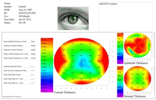 Figure 8 Corneal and epithelial thickness maps of a KCN patient.