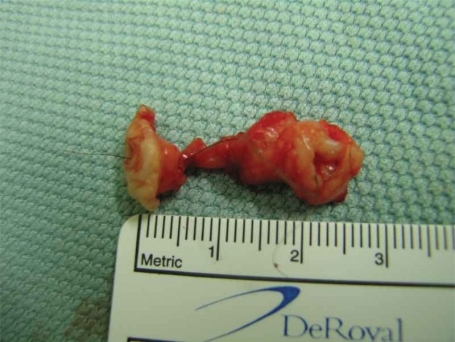 Figure 3 Gross specimen for the pilonidal sinus after excision which measures 26 mm.