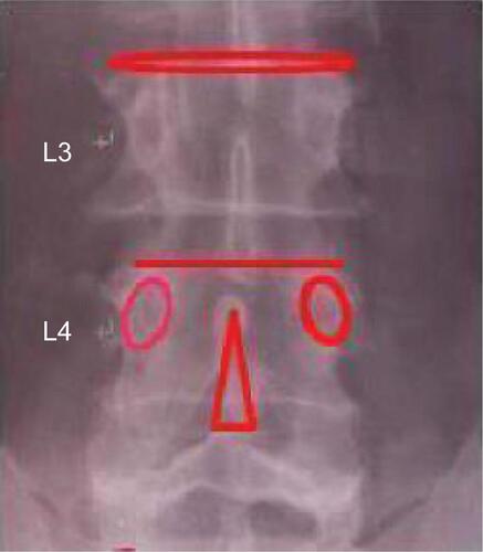 Figure S2 image of L3 and L4 by true AP view.Notes: Intraoperative radiograph showing the localizing spinal needle inserted in perfect alignment with the targeted L3 and L4 disc. C-arm fluoroscopic images were obtained to localize the true AP, when the anterior and posterior edges of vertebral end plates at L4 disc overlap in a line.Abbreviation: AP, anteroposterior.