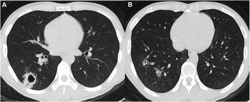 Figure 2 A 24-year-old man with HIV infection and pulmonary cryptococcosis. He has headache and fever for a week, and cryptococcal meningitis is confirmed. (A and B) Axial CT images show multiple scattered nodules with different sizes in the right lower lobe, and cavities are detected in the bigger nodules.