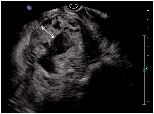 Figure 3. Thirty-nine-year-old patient, G4P1, 75 days gestation. She complained vaginal bleeding for a few days. Blood β-HCG 230 IU/ml. Ultrasound detected a thickened wall gestational mass within lower uterine segment. Multiple anechoic foci of various sizes with hypo-echoic dots could be seen within the thickened wall. The double-head arrow pointed out the thickness measurement of chorion.