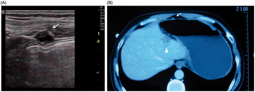 Figure 1. A 48-year-old man with well-differentiated hepatocellular carcinoma underwent percutaneous RFA. (A) Twenty-month follow-up ultrasonography shows a 10 mm seeding nodule (arrow) with hypo echo in abdominal wall. (B) CECT shows seeding nodule (arrow) and subcapsular ablation zone (arrowhead) in portal phase.