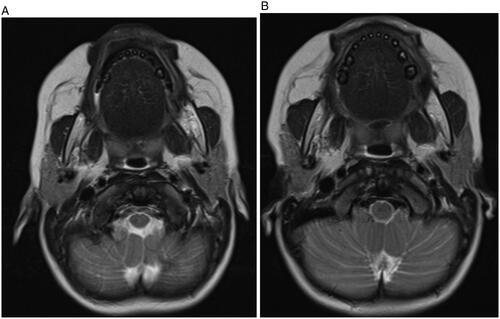 Figure 4. (A and B) Axial views of MR imaging in T2 window at 12 months (A) and 24 months (B) after diagnosis revealed further decrease in mass size along with decreased signal intensity, enhancement and bony expansion. There is only mild residual expansion of the left angle of mandible after 24 months.