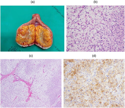 Figure 3. (a) Cross-sectional appearance of the left ovary. The ovarian tumor cut surfaces are well-circumscribed, yellowish color, and lobulated. (b) Tumor cells have round to polygonal shape with eosinophilic to clear cytoplasm and oval nucleus. (c) Tumor cells arrange in cord and sheet (*) with fibrovascular tissue (arrow). (d) Tumor cells show positive for alpha-inhibin immunostaining.