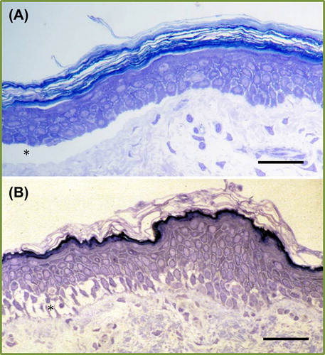 Figure 2. Light microscopic appearances of inherited skin fragility at either the dermal-epidermal junction (A) or within the lower epidermis (B). Asterisk indicates the blister formation (Richardson's stain; scale bar = 50 μm).