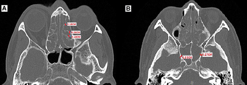 Figure 2 Radiological measurement using Global Osteitis score scale system for computed tomography of the paranasal sinuses. Measurement was made for hyperostosis area with maximal thickness of the osteitic focus in all the sinuses, for example (A) ethmoidal sinus and (B) sphenoid sinus.