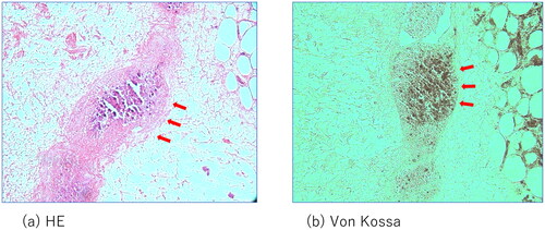 Figure 4. Pathological examination: arrows indicate the calcification in the small vessels in the subcutaneous tissue.