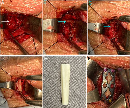 Figure 7 Images during the second operation. (A) The white arrow indicates cavities were formed, and blood fluid flowed out; (B) The white arrow indicates that the remaining bone mass at the upper edge of the C6 vertebral body cannot be inserted into the screw; (C) The white arrow indicates that the C6/7 intervertebral space was obviously damaged; (D) A fibular allogeneic bone of appropriate length was placed between the C5-7 vertebral bodies; (E) Schematic diagram of the fibular allogeneic bone; (F) The anterior cervical titanium plate was fixed in front of C5 and C7.