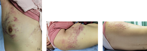 Figure 1 Figure 1a–1c: Scattered or clustered erythema and nodules almost on the right thoracic wall, armpit and back, distribution like girdle-shaped.