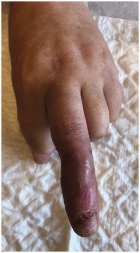 Figure 13. The ulcer healed completely within 18 weeks with scarring.