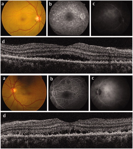 Figure 2. Right and left eye posterior segment imaging for case 2. (a) Color photography; (b) fundus fluorescein angiography; (c) indocyanine green fundal angiography; and (d) spectral domain optical coherence tomography (OCT) imaging. OCT reveals diffuse thickening of the retinal pigment epithelium (RPE) with shallow serous macular detachments bilaterally. In contrast to case 1, this patient shows no full-thickness RPE defect, with correspondingly less hyperfluorescence seen on fluorescein angiography and relatively well-preserved visual acuity. The inner retinal layers, including the papillo-macular bundle, are well preserved bilaterally.