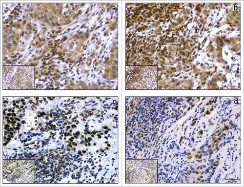 Figure 1. Representative examples of immunohistochemical expression of pMST1/2 and pLATS1/2 in 4 breast cancer cases (a,b,c,d). Panels a and b show 2 cases with cytoplasmic pMST1/2 (a) and cytoplasmic pLATS1/2 (b) expression with concomitant expression in stromal TILs. Panels c and d show 2 cases with nuclear pMST1/2 (c) and nuclear pLATS1/2 (d) expression with concomitant expression in stromal TILs. Slide magnification x 40, inset magnification x 20. Scale bar 30 μm.