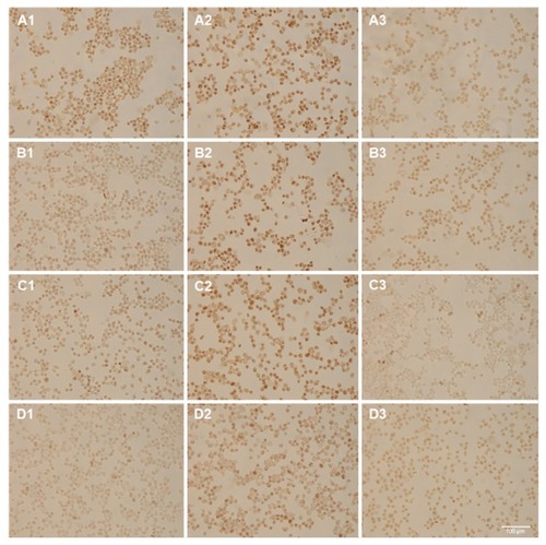 Figure 8 In situ polymerase chain reaction (ISPCR) on samples that were incubated with nanobarcoded superparamagnetic iron oxide nanoparticles at (A) 50 nM, (B) 5 nM, (C) 500 pM, or (D) 0 final concentrations for 24 hours.Notes: ISPCR cocktails contain reverse primer and template (1), HPV18 E7 primers (2), or water (negative control) (3). Scale bar is 100 μm.