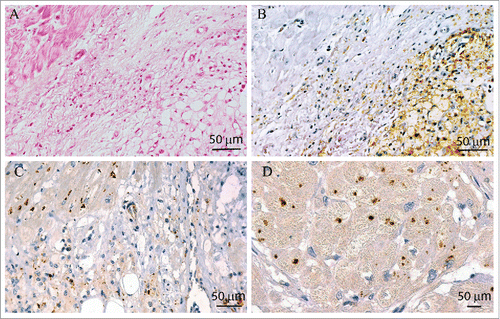 Figure 2. ECD cardiomyocytes express CgA. Immunohistochemistry on ECD myocardial tissue shows a polymorphic xanto-granulomatosous process, composed of vacuolated macrophages and lymphocytes, infiltrating normal myocardial fibers (A–C); (A) Hematoxylin & Eosin staining; (B) CD68 staining is expressed by foamy macrophages; (C) 5A8 staining, directed against the NH2 terminal vasostatin-1 domain of CgA, shows a granular staining of myocyte cytoplasm. In (D) 5A8 staining on cross-section of myocardial fibers at higher magnification.