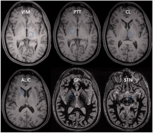 Figure 1. Current and future targets for MR-guided focused ultrasound. Ventral intermediate nucleus of the thalamus (VIM) for treatment of essential tremor. Pallidothalamic tract (PTT) for treatment of Parkinson’s disease (PD). Central lateral nucleus of thalamus (CL) for treatment of chronic pain. Anterior limb of internal capsule (ALIC) for treatment of OCD. Globus pallidus internus (GPi) for possible treatment of PD. Subthalamic nucleus (STN) for possible treatment of PD.