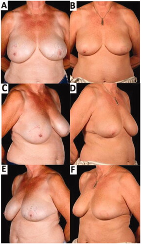 Figure 4. Pre-operative (A,C,E) and 8-months post-operative (B,D,F) appearances of a 61-year-old patient who underwent breast-conserving surgery comprising a redo-wide local excision (central and inferior segmental resection including the NAC) reconstructed with a laterally-based Grisotti flap and an inferiorly-based secondary dermoglandular pedicle and simultaneous contralateral symmetrising breast reduction – 6 months after completion of adjuvant radiotherapy. The improved breast symmetry was made possible by the complex oncoplastic techniques. The patient declined formal nipple reconstruction preferring intermittent use of a prosthetic nipple. There was no residual visible skin reaction from the radiotherapy treatment.