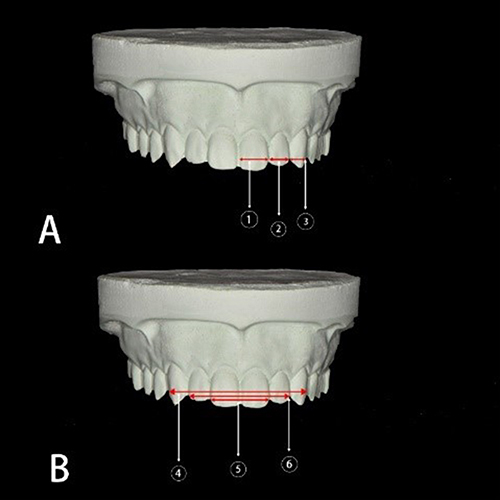 Figure 1 Study cast of the participant during width measurements of central, lateral, canines (A) and both incisors, both laterals, and maxillary 6 anterior teeth width (B).