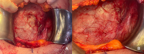 Figure 5 Intraoperative findings in May 2023. (A) and (B) show the intraoperative view of the anterior uterine wall at the level of hysterotomy during cesarean section. The cystic adenomyoma is not visible.