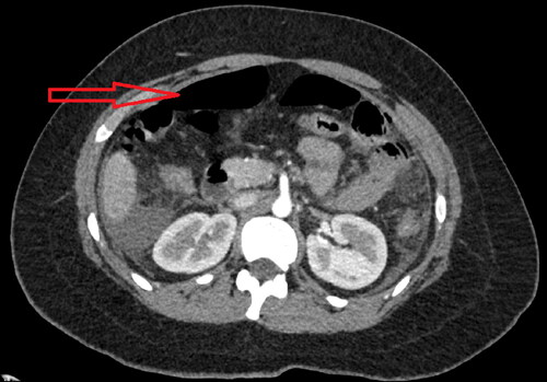 Figure 1. CT scan demonstrating pneumoperitoneum.