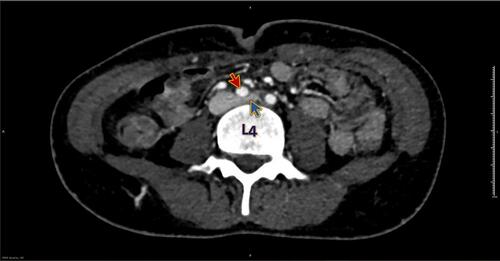 Figure 1 CT venogram axial view shows compression of the left iliac vein (blue arrow) by the right iliac artery (red arrow) at the level of the 4th lumbar vertebra (L4).