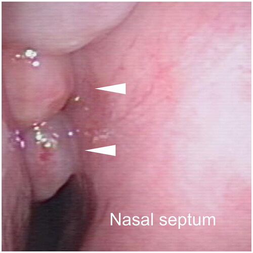 Figure 3. Endoscopic image of the right nasal cavity. Nasal polyps reaching the common nasal meatus are visualized (arrow head).