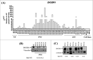 Figure 1. Expression of DICER1 in human thyroid carcinoma tissues and cell lines. (A) Expression of DICER1 was evaluated by q-RT-PCR in normal thyroid tissues (NT, n = 3), papillary thyroid carcinomas (PTC, n = 31), anaplastic thyroid carcinomas (ATC, n = 14) and human thyroid carcinoma cell lines (TPC-1, BCPAP, FRO, 8505c). RP18S was used as housekeeping gene. Expression levels were relative to NT. (PTC vs. NT, p = 0.049; ATC vs. NT, p = 0.048; cell lines vs. NT, p = 0.002). The DICER1 protein levels were assessed by western blot in (B) NT (1) and PTC (6) samples and, (C) four normal/ PTC paired samples. The results of the densitometric analysis were normalized by vinculin and γ-tubulin levels and relative to NT ± SD.