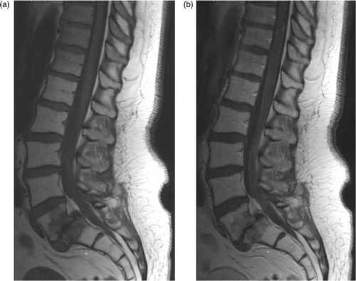 Figure 1. MRI of the lumbosacral spine of patient with HTNR 1497. T1-weighted images before, (a), and after, (b), the administration of gadolinium show enhancement of the conus and cauda equine. In addition, degenerative changes including listhesis are present at the L5-S1 level.
