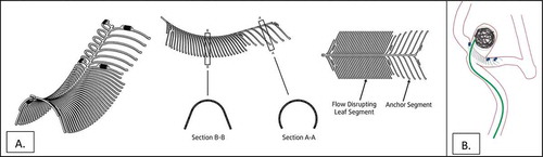 Figure 1. (a). Illustration of eCLIPs device in 3-D (left), side (middle) and plan (right) views. (b). Illustration of eCLIPs device deployed with anchor segment in sidebranch and leaf portion bridging the neck, behind which are coils delivered by catheter penetrating ribs of leaf portion.