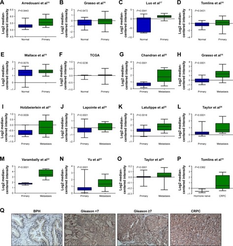 Figure 1 ABCC5 as a potential metastasis and castration resistance-associated oncogene in PCa. (A–F) Box plots represent ABCC5 mRNA level in BPH and primary PCa samples; (G–O) ABCC5 mRNA in primary PCa and metastatic PCa samples; (P) box plots represent ABCC5 mRNA in hormone naïve PCa and CRPC samples; (Q) immunohistochemical analysis of ABCC5 in BPH, less aggressive PCa, aggressive PCa, and CRPC.