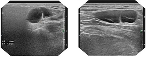 Figure 1 CEUS examination results of cervical lymph nodes in DLBCL patients. Several hypoechoic nodules can be seen on both sides of the neck, with clear boundaries, capsules, and abnormal ratio of cortex to medulla. The larger one on the left and the right is located in the V area, and the size is 21*19mm/19*9mm. CDFI Shows blood flow signals in the bilateral hypoechoic nodules of the neck. CEUS examination result suggests multiple lymph nodes on both sides of the neck.