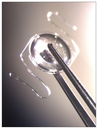 Figure 2 Intraocular Lens for Visually Impaired People (IOL-VIP System; Soleko, Pontecorvo, Italy).Citation16