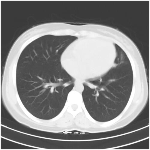 Figure 1. CT scan of the chest of a pregnant woman infected with Listeria monocytogenes in the second trimester.