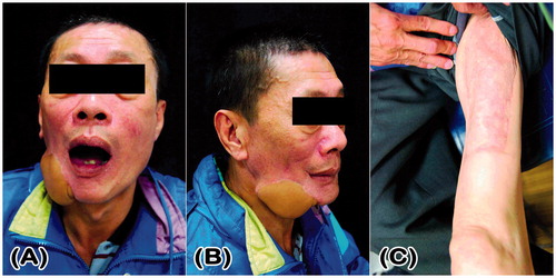Figure 2. At a follow-up of 2 years and 11 months in Case 1, there are no reconstruction plate exposures or trismus (A), except bulky flap (B), and the grafted donor site is unobtrusive (C).