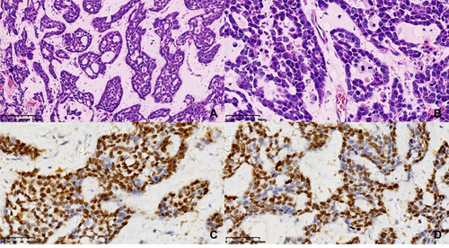 Figure 1 Pathological and immunohistochemical results. Tumor cells were arranged in nests, lobules or trabecular basaloid cells. Nuclear palisading was arranged in the peripheral region of tumor nests with hyaline-like materials identified (HE: A×200, B×400). Tumor cells were positive for P63 (C×400) and P40 (D×400) in immunohistochemical results.