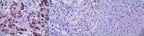 Figure 5 Expression of pERK1/2. (A) Positive expression of pERK1/2 in HCC×200. (B) Suspected positive expression of pERK1/2 in HBV-LC ×200. (C) Negative expression of pERK1/2 in normal liver tissue×200.