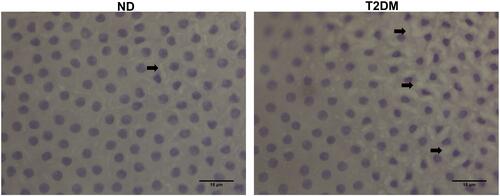 Figure 1 Hematoxylin-eosin staining (40x) showing cell retraction and cytoplasmic vacuolization (black arrows), sparse in ND and abundant in T2DM samples.