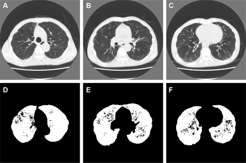 Figure S2 Representative computed tomography (CT) images and results of preprocessing of the upper, middle, and lower lung fields in a 64-year-old man with COPD.Notes: Forced expiratory volume in 1 second (FEV1)/forced vital capacity; FEV1; b0, b1, R; and the percentage of low-attenuation lung area were 67.4%; 61.4%; 944, 39, 0.0413; and 5.13%, respectively (b0, the zero-dimensional Betti number; b1, the one-dimensional Betti number; R, b1/b0). The CT images and the binarized images are shown in (A–C) and (D–F), respectively.