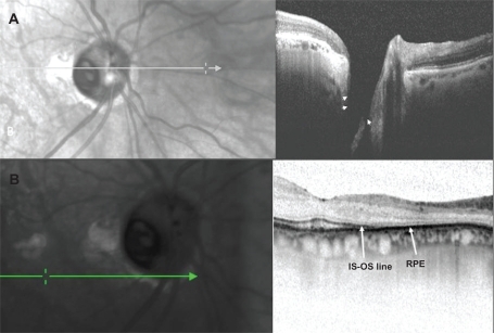 Figure 2 A) Combined infrared imaging and SD-OCT (spectralis; Heidelberg engineering, Germany) demonstrate excavation of the optic nerve with an adjacent area of outer retinal atrophy. Arrow heads pointing to the excavation seen on spectralis OCT. B) spectralis OCT scan demonstrates loss of the photoreceptor outer segments with preservation of the underlying retinal pigment epithelium. Arrow indicating the point where inner segment–outer segment junction of the photoreceptor becomes discontinues indicating atrophy. RPE is seen as a dark continuous band.
