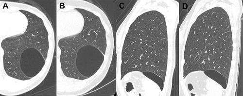 Figure 1 Chest CT scans demonstrated solitary huge lung cyst in the posterior basal segment of left lower lobe. (A) axial image, 2017; (B) axial image, 2019; (C) sagittal reformation image, 2017; (D) sagittal reformation image, 2019.