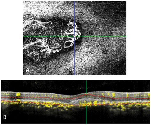Figure 4. OCT A (A) shows CNV in the choriocapillaris layer on OS. (B) B Scan demonstrated persistent flow in CNV.