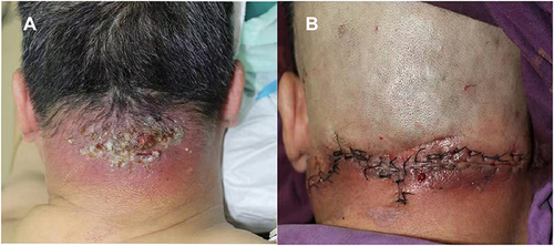 Figure 3 Patient 3: (A) lesion on admission. (B) lesion after surgical debridement and drainage.