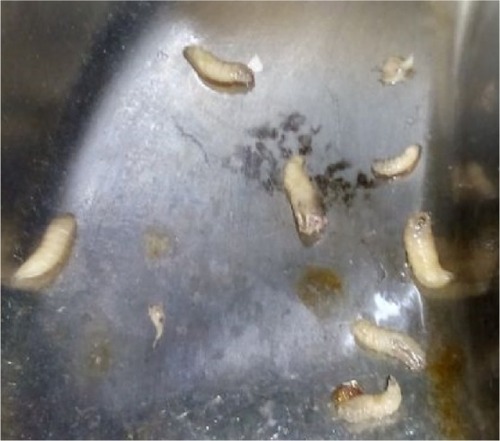 Figure 6 Maggots removed from patient’s wound.