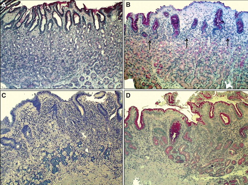 Figure 2. Corpus mucosa. Normal (A): The layer of oxyntic glands is normal suggesting that the corpus mucosa is capable to secrete hydrochloric acid normally. Non-atrophic gastritis (B): Mild mononuclear inflammation is seen in upper layer (foveolar part) of the mucosa (“superficial chronic gastritis”) as indicated with arrows. The gland layer is intact suggesting that the acid secretion is normal in spite of the gastritis. Moderate atrophic gastritis in corpus (C): Intense chronic mononuclear inflammation occurs also in lower layers of the mucosa and is accompanied with a marked loss (atrophy) of normal oxyntic glands. The observation suggests that the stomach is hypochlorhydric but is not achlorhydric. Acid secretion is impaired due to loss of the parietal cells. Severe atrophic gastritis in corpus (D): Chronic inflammation is mild but all oxyntic glands are totally gone. Some foci of intestinal metaplasia occur in the lower right corner. Stomach is certainly acid free (achlorhydric). The patient is at risk for malabsorption of vitamin B12, and also the absorption of micronutrients (iron, calcium, magnesium and zinc) may be impaired. The pathologist may have difficulties to find Helicobacter pylori organisms in cases like this even though the atrophic gastritis would be of H. pylori origin. Instead, a mixed microbial flora (microbes other than H. pylori) is a common finding on the surface mucosa in cases like this. Alcian blue – PAS and modified Giemsa stains × 300.