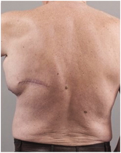 Figure 3. Preoperative posterior view of the patient showing the presence of the large left axillary encapsulated seroma and the malignant melanoma scar.