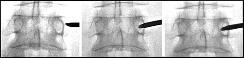 Figure 7 AP view showing progression of the trocar from the lateral to medial pedicle border while simultaneously traversing towards the posterior aspect of the lumbar vertebral body. As the trocar is advanced it is important that the stylet tip not pass the medial border of the lumbar pedicle in the AP view until it breaches the posterior vertebral body wall in the lateral view.