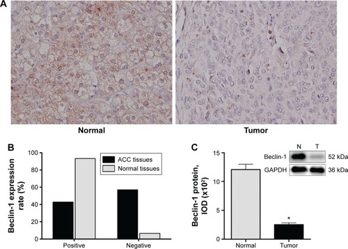 Figure 1 Beclin-1 expression in human ACC and normal adrenocortical tissues.