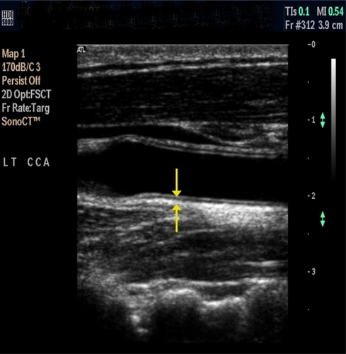 Figure 1 Carotid intima-media thickness measured at the far wall of the common carotid artery using the double-line pattern.