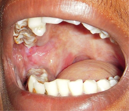 Figure 4 Redness and irregular cobble-stone appearance in oral submucous fibrosis.