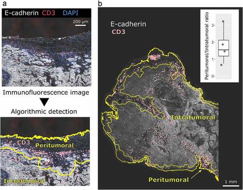 Figure 3. CD3 cells are mainly located peritumorally in the orthotopic mEERL95 tumors. a: Example of the algorithmic detection of CD3 and E-cadherin immunostaining signal on frozen sections from orthotopic mEERL95 tumors. The epithelial-specific E-cadherin and nuclear DAPI signals are used to accurately define the peritumoral and intratumoral areas of the sample. b: Overview of a whole tumor section showing that CD3 T-cells are preferentially found in the peritumoral area. (inset): Quantification of the ratio between CD3 T-cells detected in the peritumoral area versus CD3 T-cells detected in the intratumoral area in PBS treated mice (n = 4)